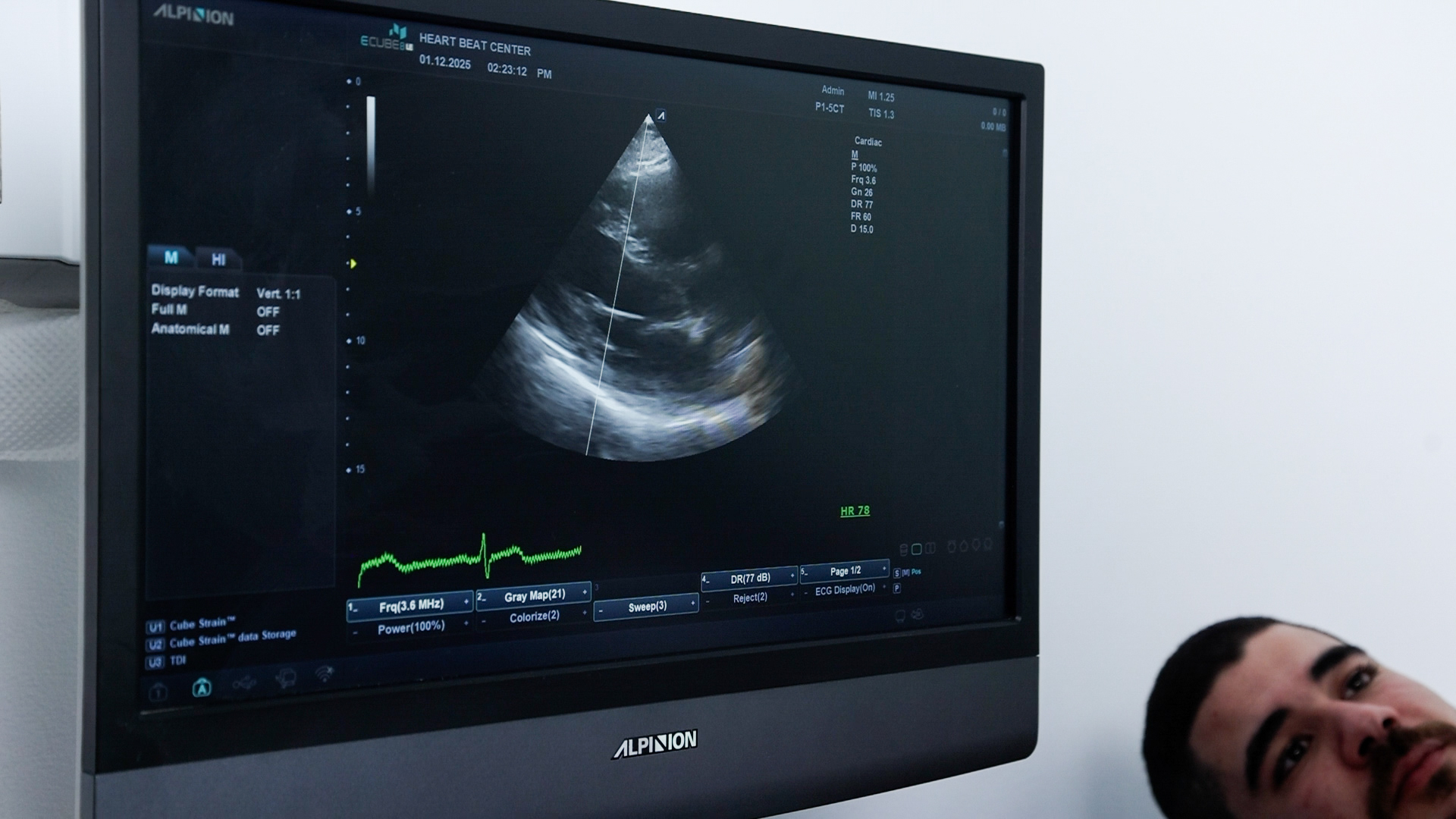 الموجات فوق الصوتية على القلب (إيكو)