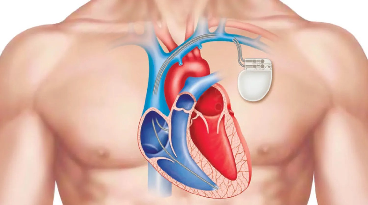 الرجفان الأذيني (AFib)